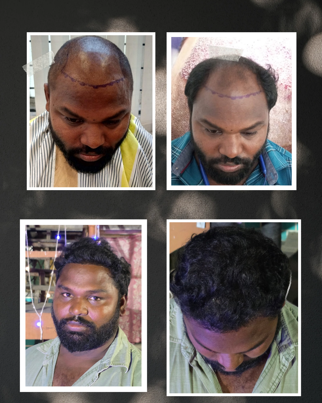 FUE hair transplantation treatment image C